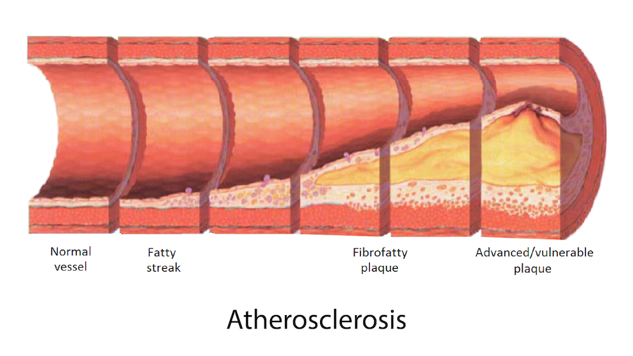 Late complications of Atherosclerosis 