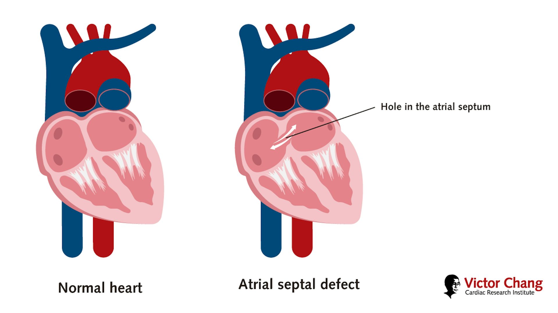 Atrial Septal Defect (ASD):… | Victor Chang Cardiac Research Institute