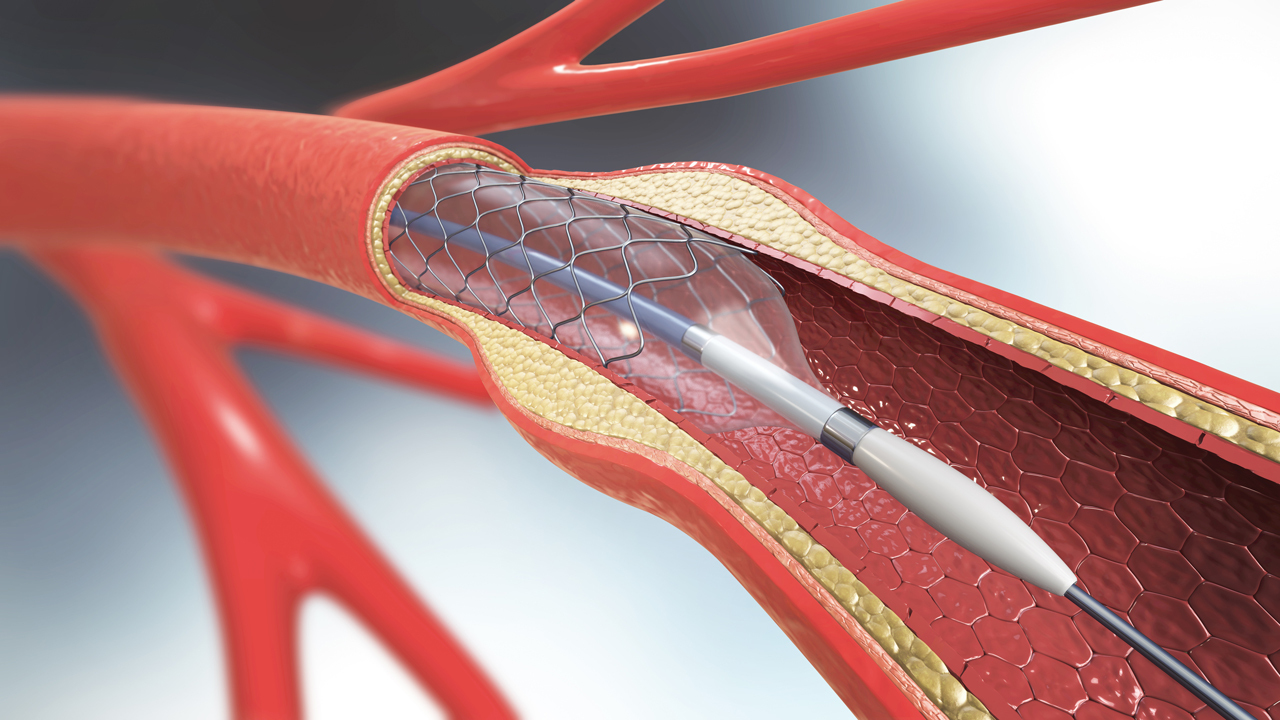 Stents | Victor Chang Cardiac Research Institute